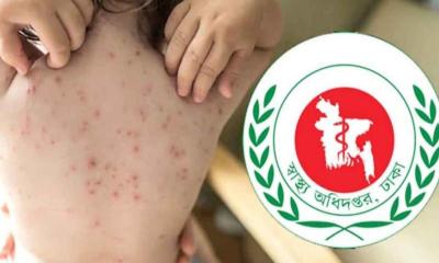 বাংলাদেশে হামের প্রকোপ নিয়ে ডব্লিউএইচও-র ‘উচ্চ ঝুঁকি’ সতর্কতা