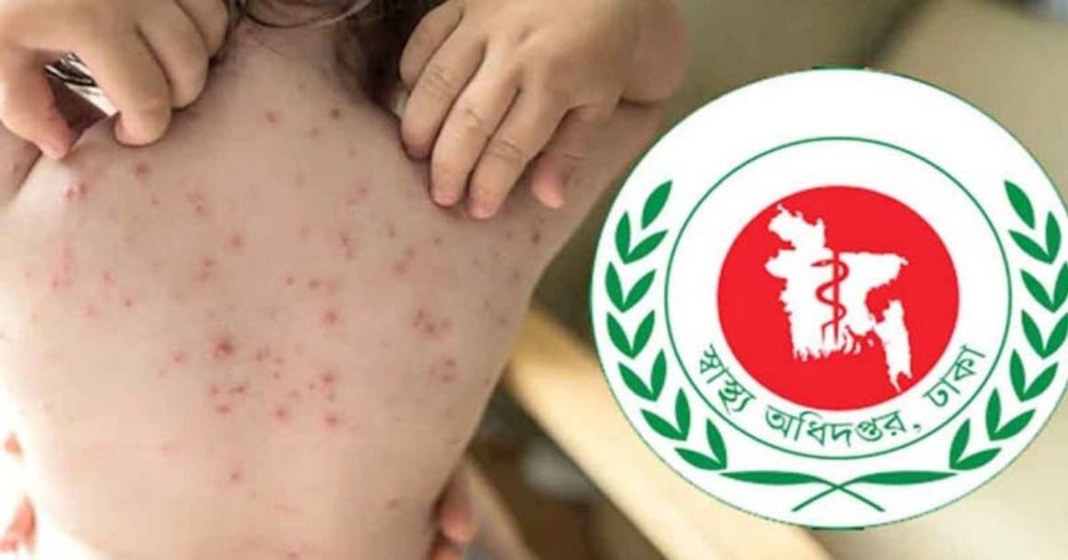 বাংলাদেশে হামের প্রকোপ নিয়ে ডব্লিউএইচও-র ‘উচ্চ ঝুঁকি’ সতর্কতা